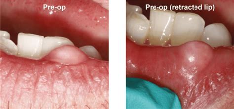 Fibroma Removal