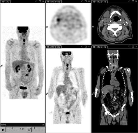 18f Fdg Pet Ct Performed At Staging In A Patient With Laryngeal