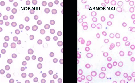 Figure Iron Deficiency Anemia Image Courtesy S Bhimji Md