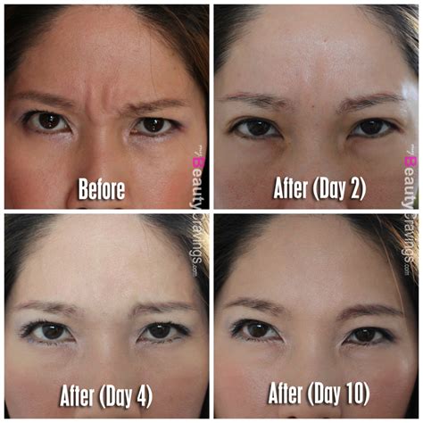 List 98 Wallpaper Best Treatment For Deep Forehead Wrinkles Sharp