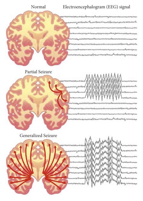Comparison Of The Normal Brain With Partial Focal Seizure And