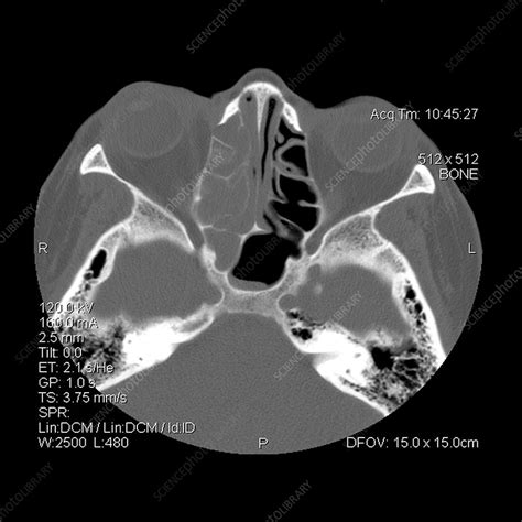 CT Of Ethmoid And Sphenoid Sinusitis Stock Image M Science Photo Library