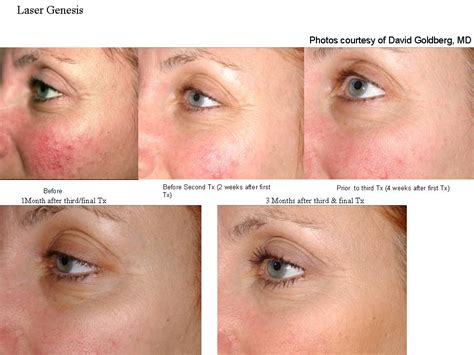 Laser Genesis Skin Rejuvenation Face R X Medspa