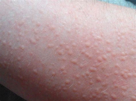 Cholinergic Urticaria Symptoms Treatment And Causes