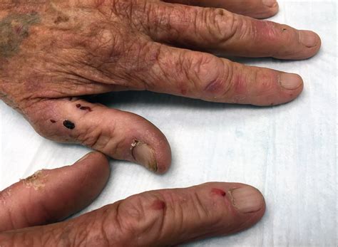 Painless Vesicular Eruption On The Dorsal Surfaces Of The Hands