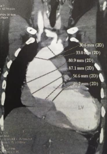Modified Bentalls Procedure For Annuloaortic Ectasia With Severe Left