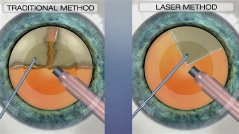 Cataract Treatment Options