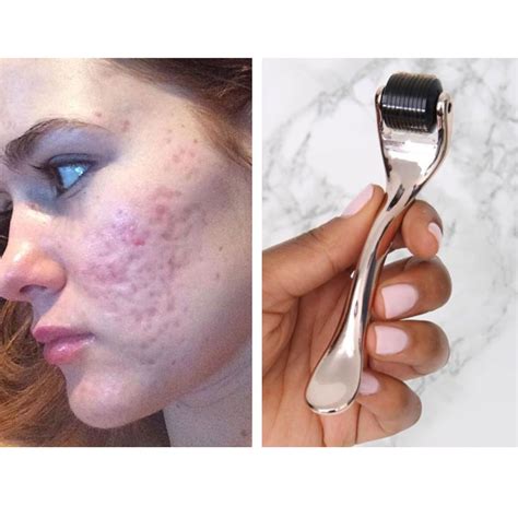 Revision Schrägstrich Kann Ignoriert Werden Derma Roller For Dark Spots