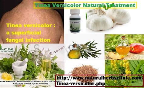 Natural Herbs Clinic Tinea Versicolor Natural Treatment Lookbook