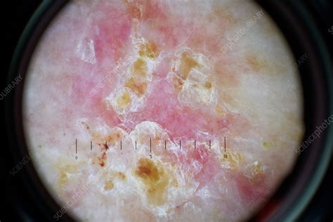 Basal Cell Carcinoma Skin Cancer Dermoscopy Image Stock Image C034