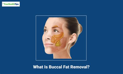 What Is Buccal Fat Removal All You Need To Know