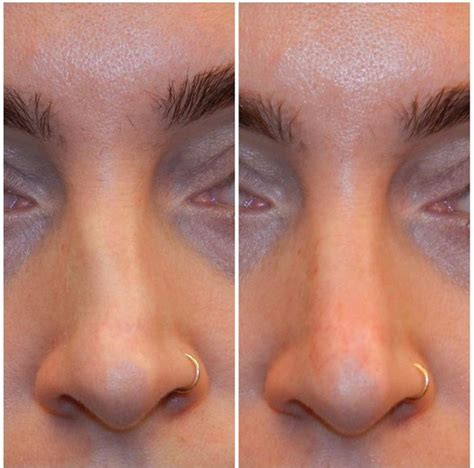 Liquid Nose Jobs Everything To Know About Nonsurgical Rhinoplasty