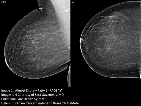 Your Patient Got A Dense Breast Notification With Her Mammogram Report