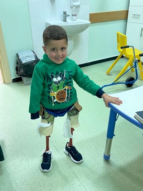Two Amputee Children Receive Rehabilitation And Prosthesis Treatment
