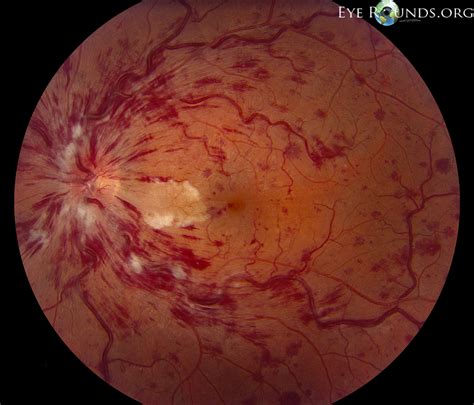 Atlas Entry Central Retinal Vein Occlusion With Cilioretinal Artery
