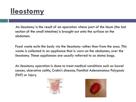 Ppt A Little Bit Of Information About Stoma Powerpoint