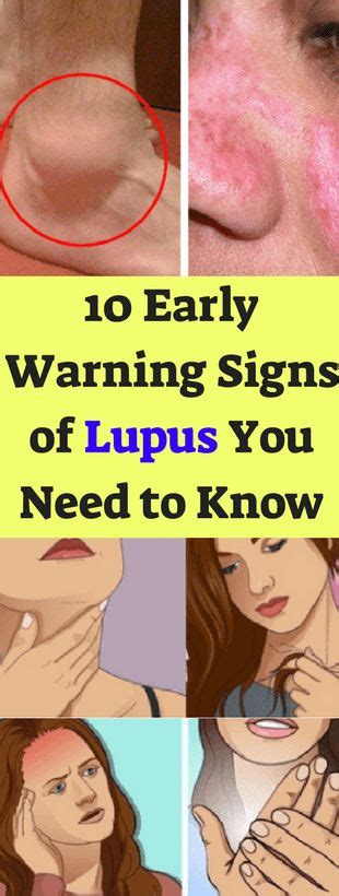 Early Warning Signs Of Lupus You Need To Know Fitstomach Health