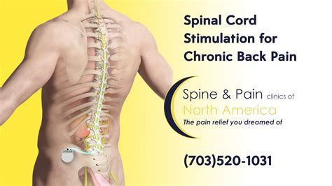 Spinal Cord Stimulation Sapna Spine And Pain Clinic Of North America