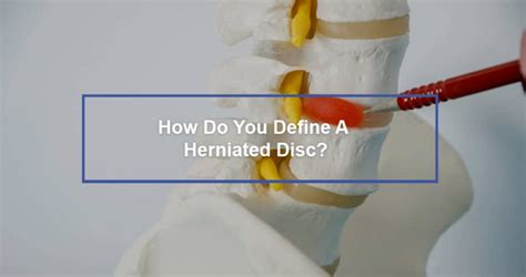 How Do You Define A Herniated Disc Dr Kevin Pauza