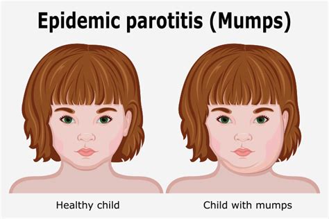 What Is Parotitis Or Mumps Mecs