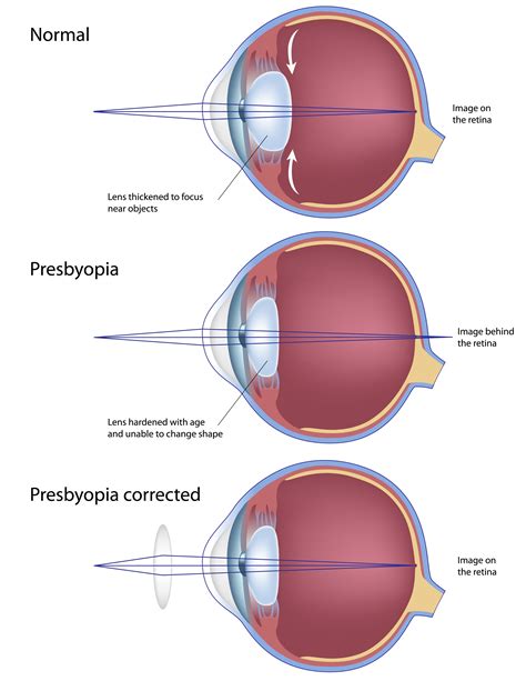 Presbyopia Laservision Victoria
