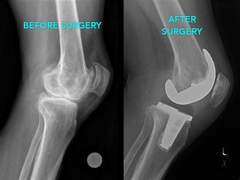 Total Knee Arthroplasty Rodriguez Hip And Knee