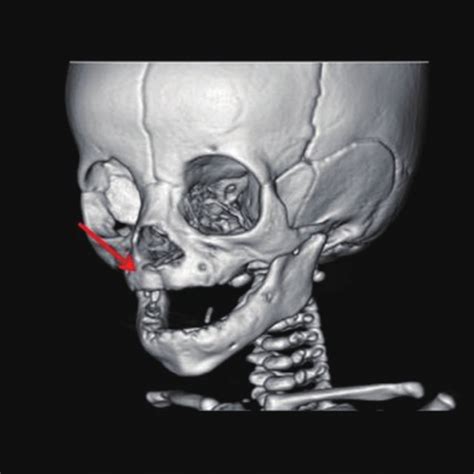 Preoperative Facial Three Dimensional Computed Tomography It Shows The