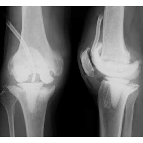 A Anteroposterior Radiograph Of Right Knee After Primary Tka B