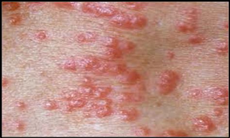 Rashes That Look Like Scabies Causes Symptoms And Treatment Hot Sex
