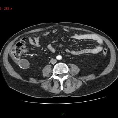 Contrast Enanched Ct Scan Showing Enlarged Appendix With Abnormal