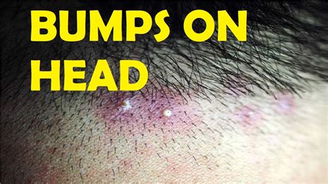 How To Get Rid Of Bumps On Head After Haircut Youtube