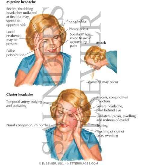 Headache Tension Cluster And Migraine