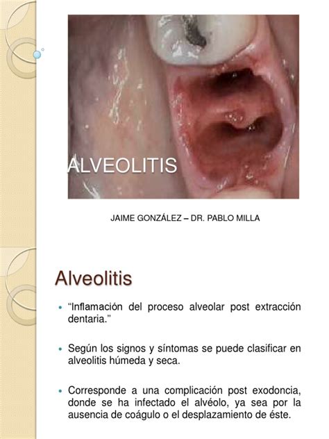 Alveolitis 130527180045 Phpapp02 Cuidado De La Salud Salud Pública