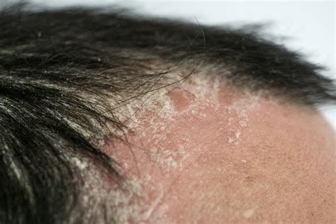 Not Just Moderate To Severe Plaque Psoriasis New Categories For