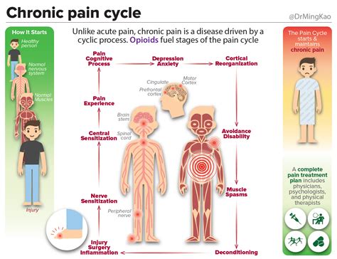 Chronic pain cycle. Unlike acute pain (pain after surgery… | by Dr ...
