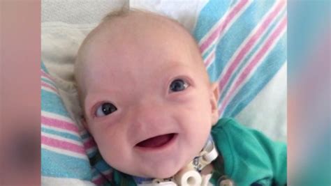 Miracle Baby Eli Born Without A Nose Dies At 2 Wset