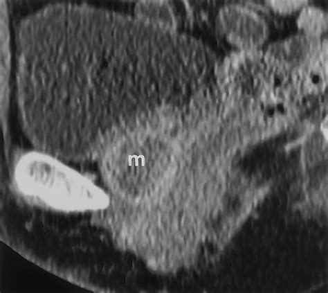 Imaging Of Urethral Disease A Pictorial Review Radiographics