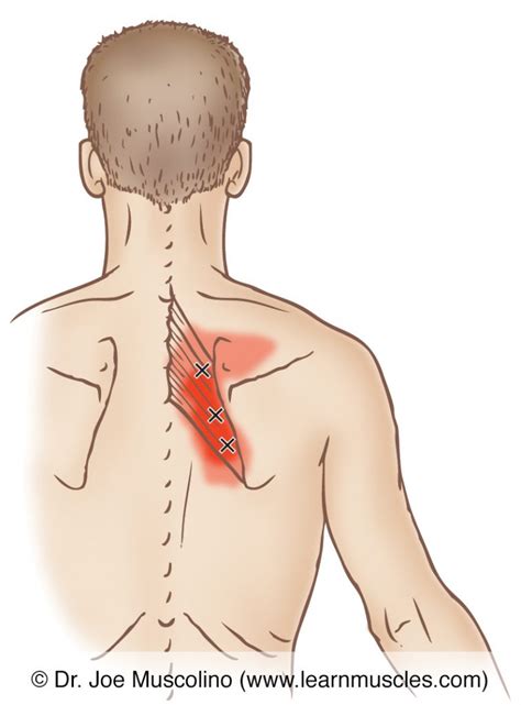 Rhomboids Trigger Points Learn Muscles