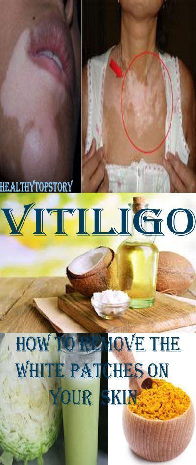 Remove And Stop The White Patches On Your Skin Vitiligo