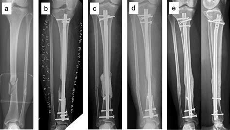 26 Year Old Female With A Closed Segmental Tibia Fracture After A Fall