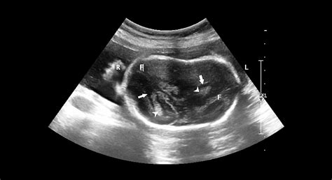 Cureus Utility Of Fetal Magnetic Resonance Imaging After Ultrasound