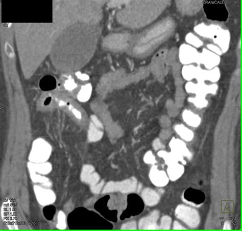 Crohns Disease Of The Terminal Ileum With Strictures Small Bowel