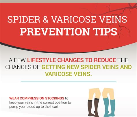 How To Prevent Spider Varicose Veins Thumbnail 01 Europe