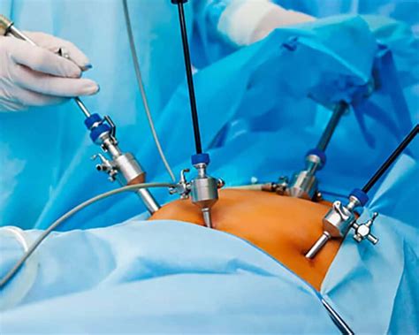 Cirurgia por Videolaparoscopia RR Médicos Cirurgiões