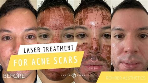 Strongest Laser Treatment For Acne Scars Is Rohrer Aesthetics Fully