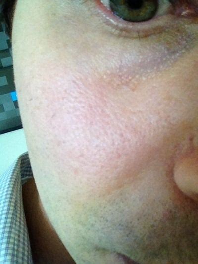 How Can I Improve The Texture Of Orange Peel Skin With Rosacea