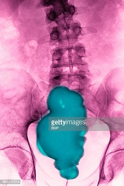 Pelvic X Ray Photos And Premium High Res Pictures Getty Images