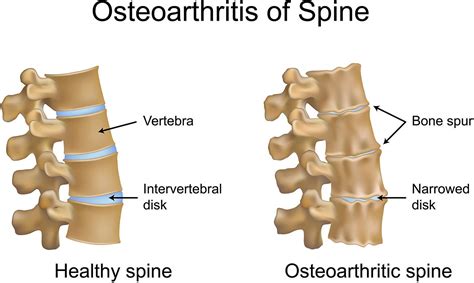 Best Excercises For Spinal Arthritis The Medical Times