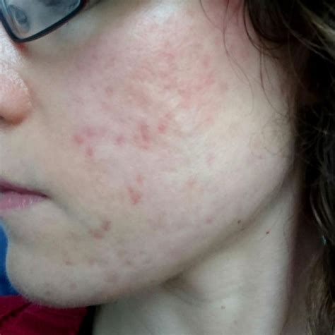 Roaccutane On The Nhs A Uk Blog Accutane Isotretinoin Logs By