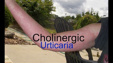 Cholinergic Urticaria Heatstress Induced Youtube